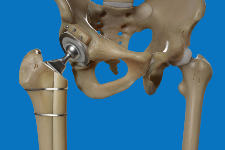 Hip Revision Surgery Medical Diagram