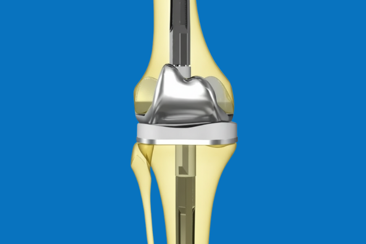 Knee Revision Surgery Medical Diagram