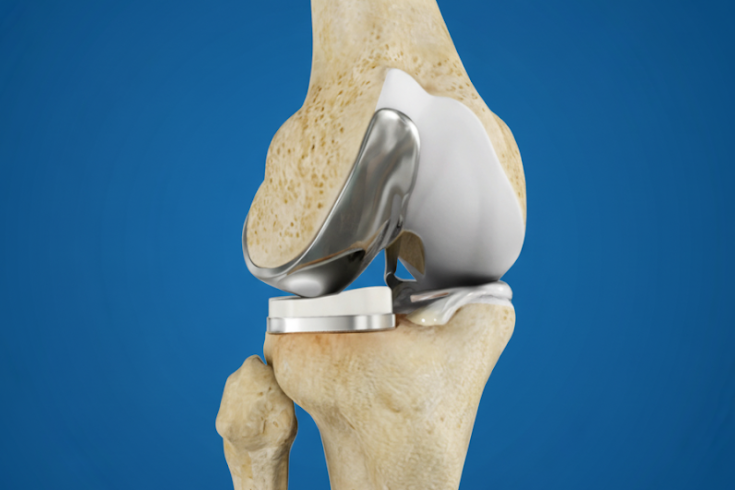 Partial Knee Replacement Medical Diagram