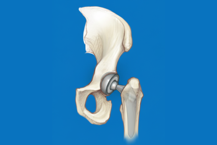 Total Hip Replacement Medical Diagram